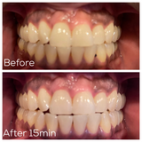 The most advanced technology on the market: this Kit is waterproof and wireless. Features blue light therapy and dual light therapy. You can receive a whitening session and oral care treatment all in one with this dual light therapy setting.