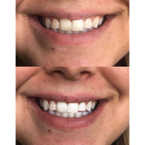 The most advanced technology on the market: this Kit is waterproof and wireless. Features blue light therapy and dual light therapy. You can receive a whitening session and oral care treatment all in one with this dual light therapy setting.